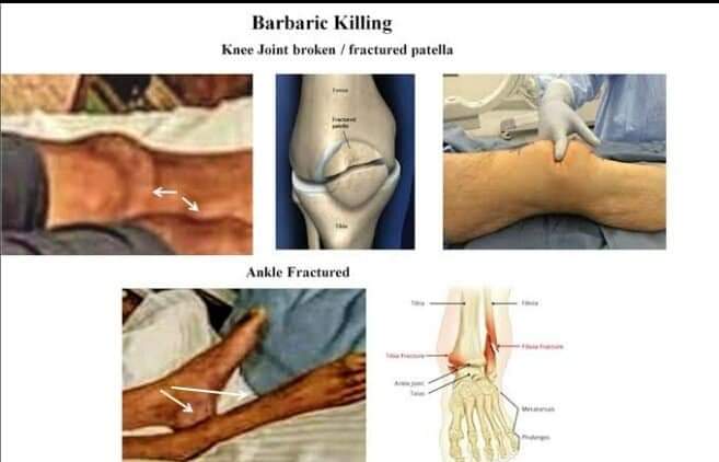 Injury Marks On sushant singh rajput Body सुशांत को बेहद क्रूरता से मारा गया था, घुटना और पैर की उँगलियाँ टूटी थी गले पर गहरे चोट के निशान थे
